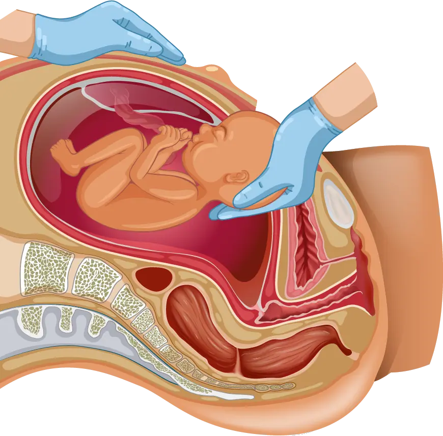 cesarean birth
